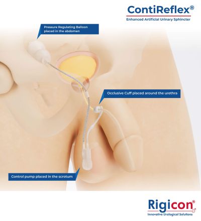 رسم توضيحي لمنتج المصرة البولية الاصطناعية المطوّرة ContiReflex