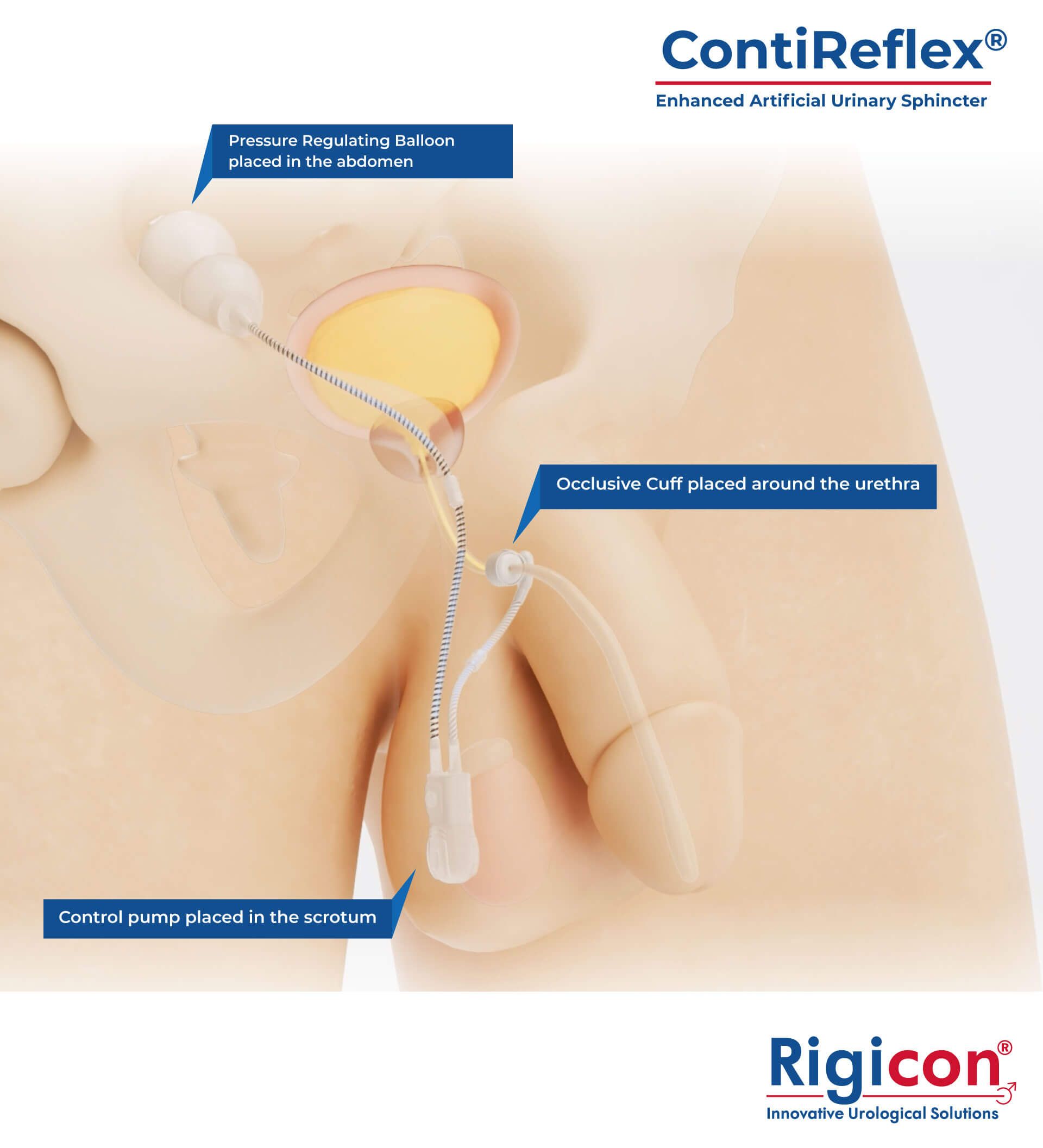 رسم توضيحي لمنتج المصرة البولية الاصطناعية المطوّرة ContiReflex